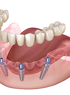 Illustration showing All-on-4 dental implants