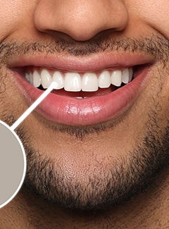 Man’s smile with a traditional dental implant