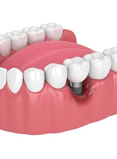 Illustration of lower arch with failed dental implant in Topeka & Silver Lake, KS